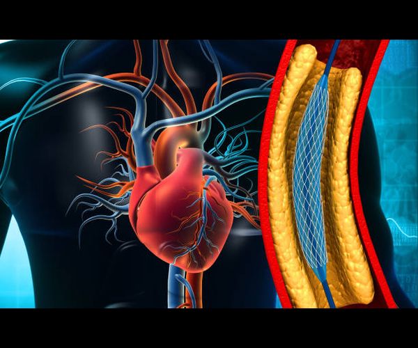 Dr. Dinesh Padole - Complex Angioplasty